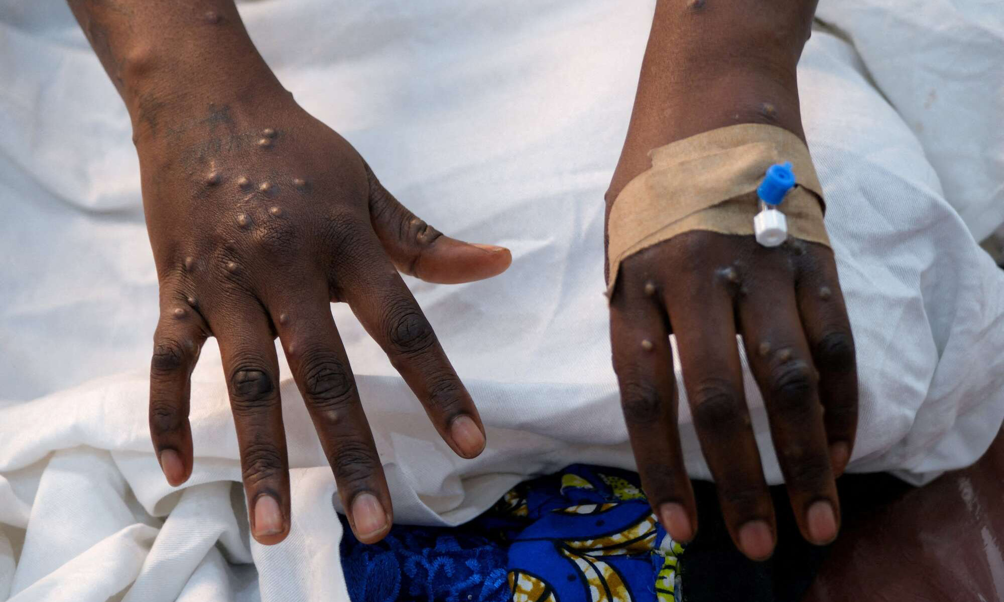 Hofu Embu baada ya kisa cha Mpox kuthibitishwa